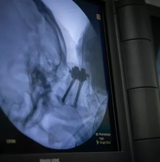 Pooperační rentgenový snímek C1-C2 zavedeného systému Ennovate Cervical v boční projekci 